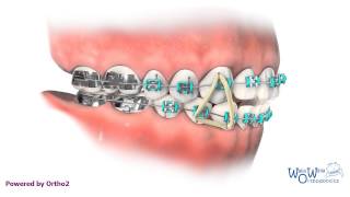 Triangle Elastics - right