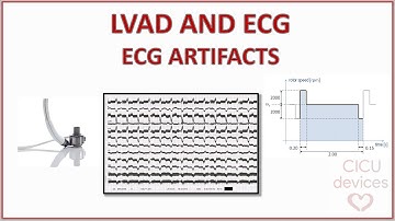 LVAD AND ECG - UNDERSTANDING ECG ARTIFACTS AND HOW TO MINIMIZE THEM