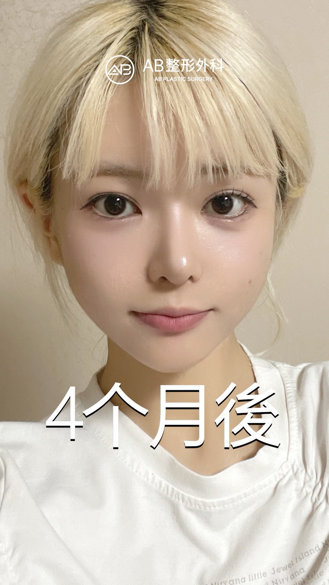 4個月變超美！韓國整形真的太神了！ #shorts