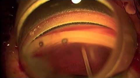 Istent implantation -Dr. Paul Singh