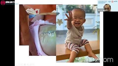 [CME 1.1] Bệnh lý bẩm sinh: Bất thường thành bụng - Tắc ruột sơ sinh (2022) BS Nguyễn Hữu Chí