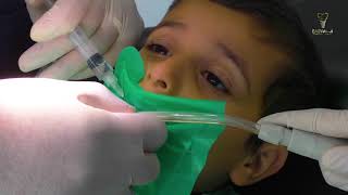 علاج أسنان طفلك أسهل - تجربة الطفل عبد الله
