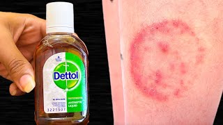 Mix one thing in Dettol and apply it. Stubborn itching, ringworm and itching of sweat will end at once.