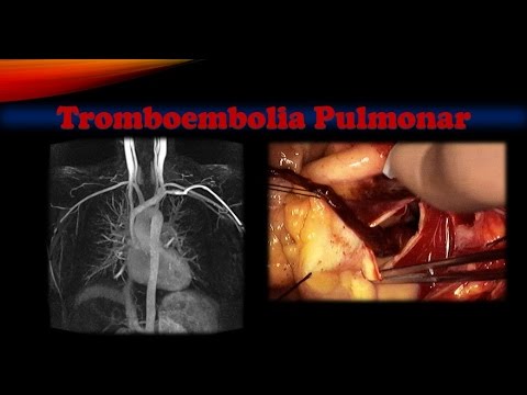 Vídeo: La Datación De La Organización Del Trombo En Casos De Embolia Pulmonar: Un Estudio De Autopsia