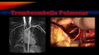 Puede embolia muerte la pulmonar causar