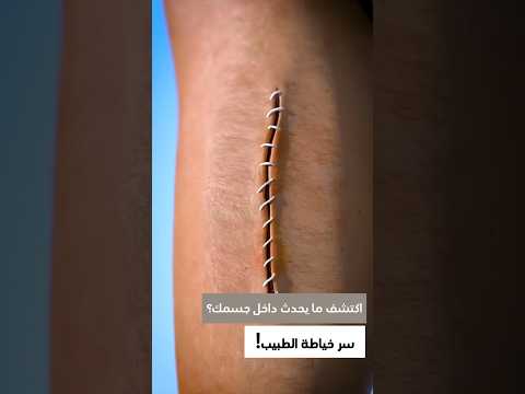 ما الذي يحدث داخل الجرح