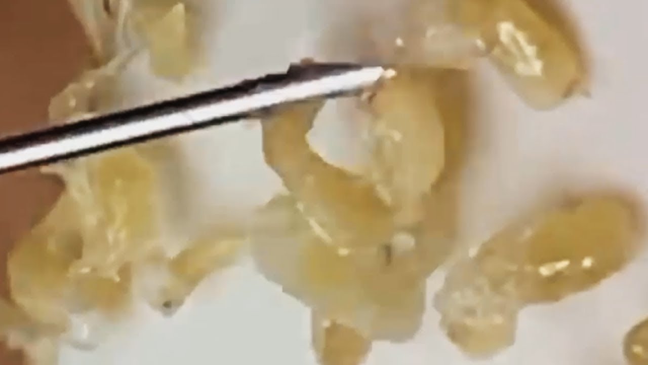 Extraction profonde des points noirs Acné kystique et popping #8 - YouTube