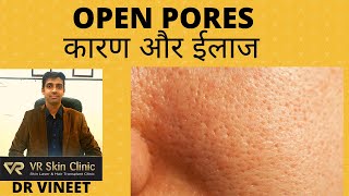 ओपन पोर्स के कारण और ईलाज | OPEN PORES CAUSES & TREATMENT| DR VINEET| BIKANER| VR SKIN CLINIC