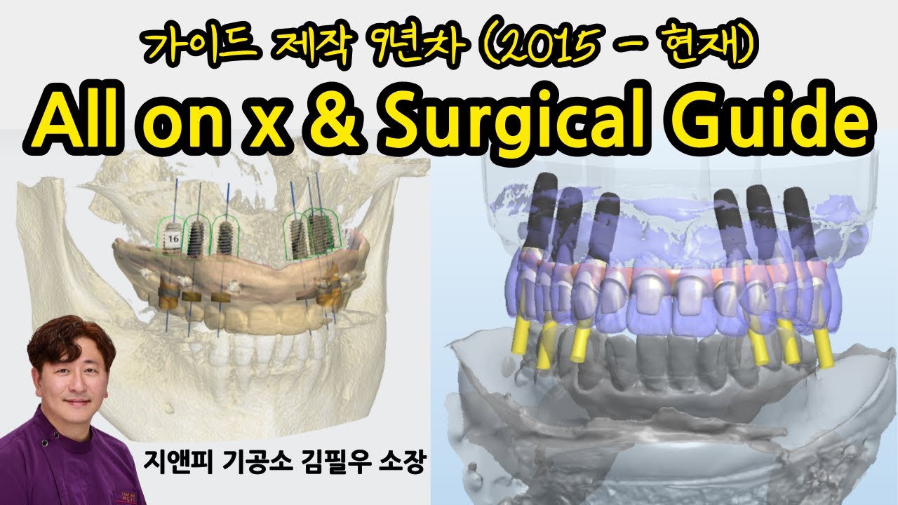 [덴탈살롱] How to make All on X