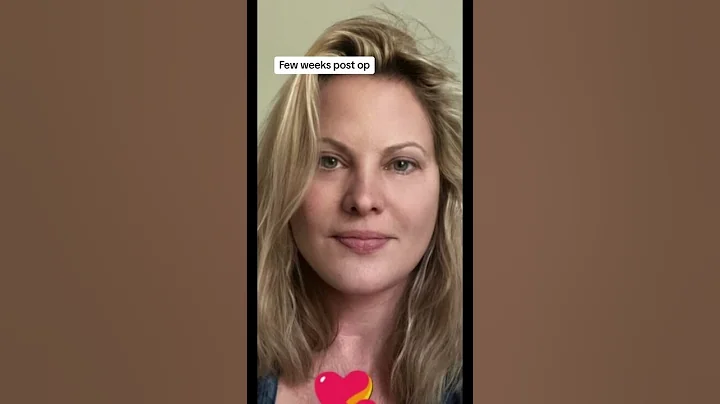 Watch Her Age in Reverse: From 64 to 35 #deepplanefacelift #facelift