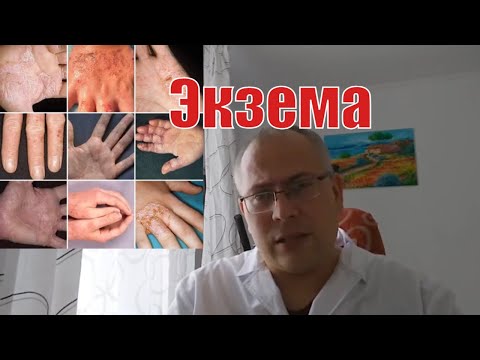 Экзема на лице, руках и ногах - причины и лечение атопического дерматита