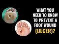 What you need to know to prevent a foot wound (ulcer)?