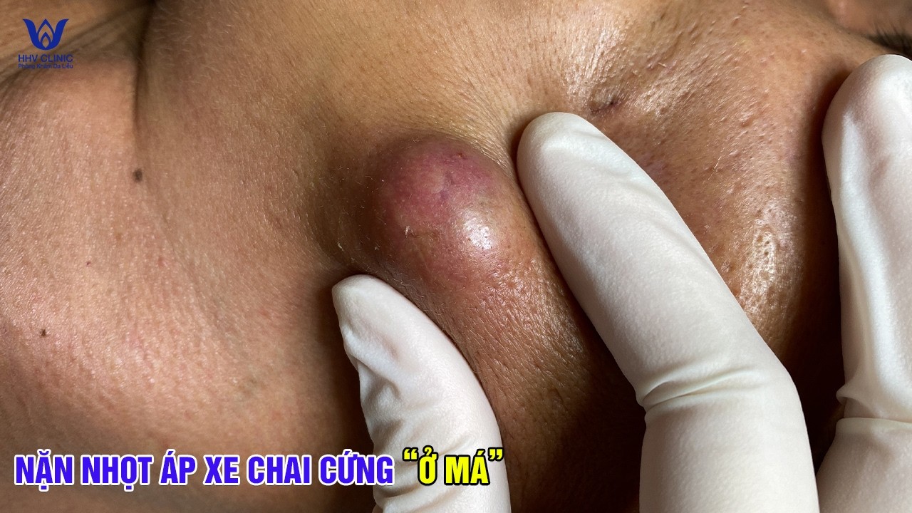 Ổ ÁP XE CHAI CỨNG Ở MÁ SƯNG TO NHƯ QUẢ TRỨNG, CẦN XỬ LÝ NGAY.
