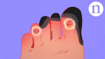 Restoring circulation: Treating critical limb ischaemia