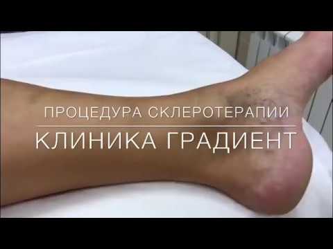 СКЛЕРОТЕРАПИЯ ВЕН - процедура инъекций препаратом Fibro-vein