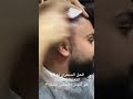 الحل السحري لعلاج الثلعبة هو الجاز الابيض الحل السحري لعلاج الثلعبة هو الجاز الابيض