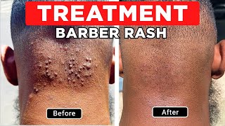 HOW I GOT RID OF RAZOR BUMPS/INGROWN HAIRS: TREATING ACNE KELOIDALIS NUCHAE