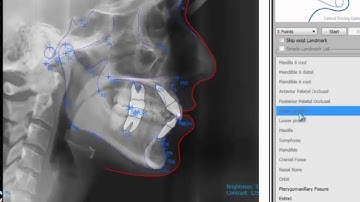 09  Tracing Editing Tutorial Video For OrthoVision