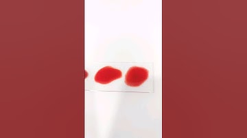 what is her blood type? #laboratory #mls #cls #medtechstudent #medtech #blood #bloodgroup #bloodtype