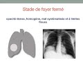 1 abcs pulmonaire   quatrime anne mdecine 