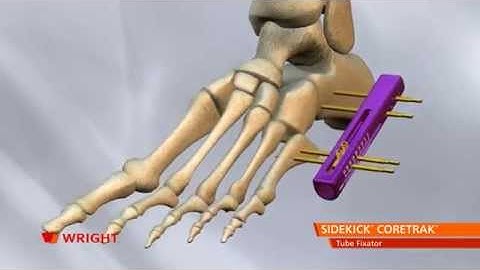 SIDEKICK™ CORETRAK™ Tube Fixator Animation