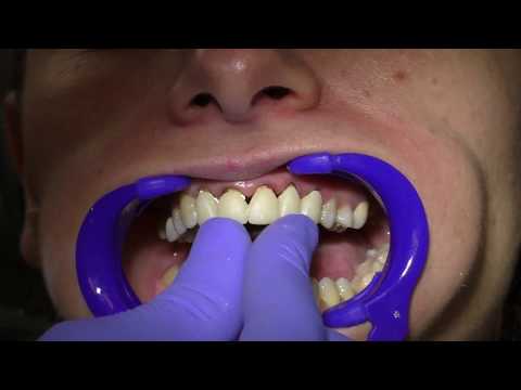NoMIX – влагоотверждаемый временный цемент. Разработан как для стоматолога, так и для пациента.