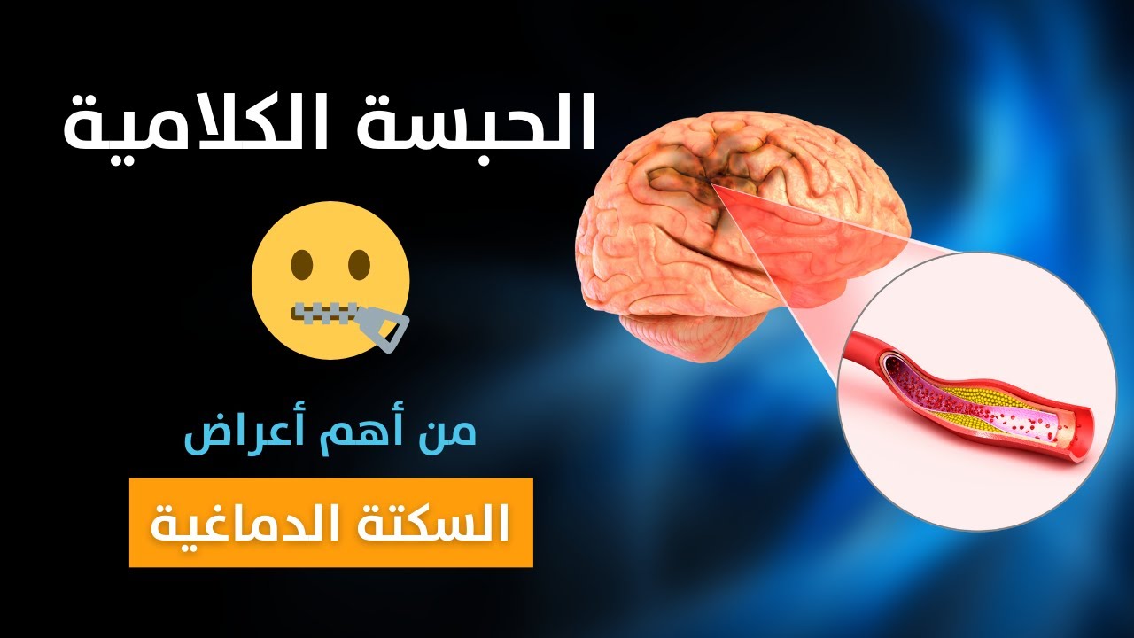 الحبسة الكلامية - من أهم أعراض السكتة الدماغية  🧠