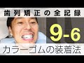 カラーゴム（カラーモジュール）の色選び＆付け方｜歯列矯正の全記録9-6