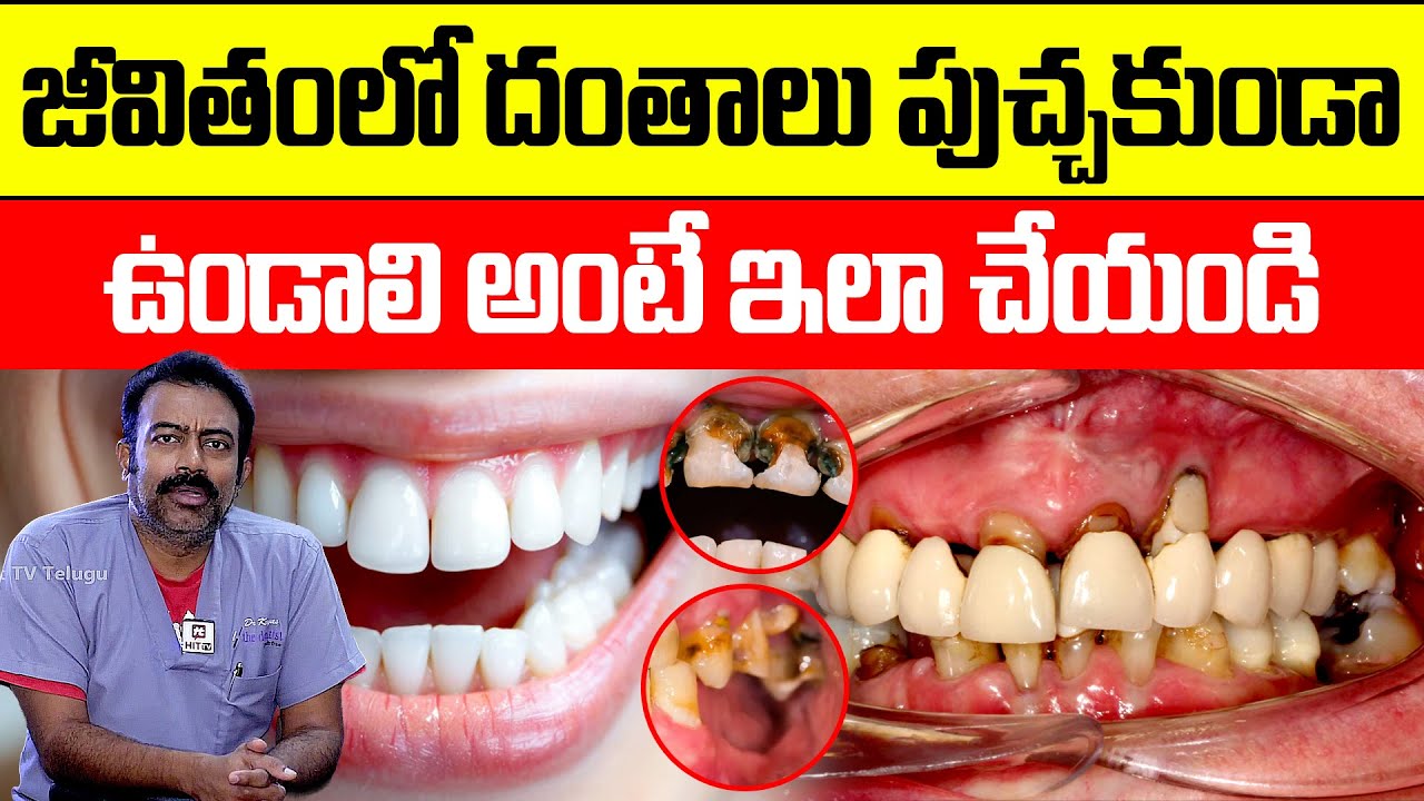 జీవితంలో దంతాలు పుచ్చకుండా ఉండాలి అంటే ఇలా చేయండిDoctor Koya Kishore Dentist