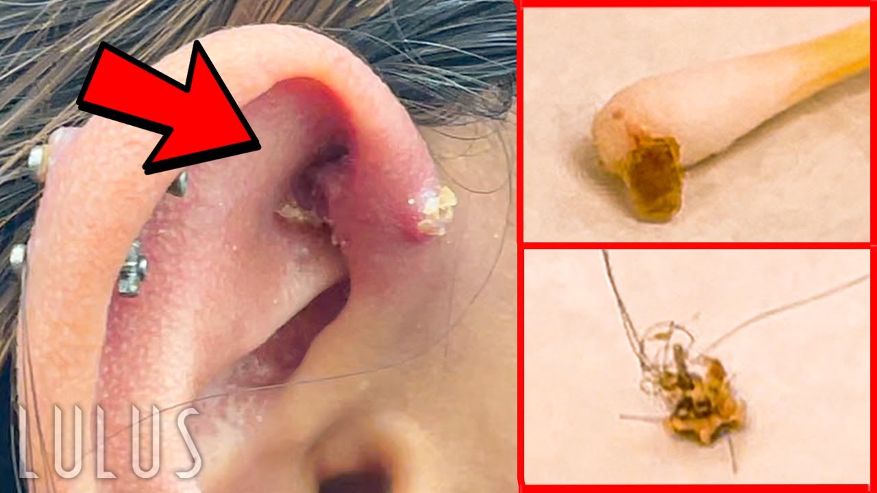 CLEAN Your Piercings Or THIS Can Happen…*REMOVAL* 