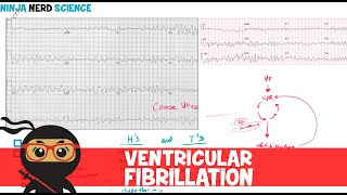 Rate and Rhythm | Ventricular Fibrillation