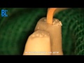 JETip Endodontic Microsurgical Ultrasonic Tip