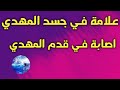 المهدي المنتظر وتعرضه لا اصابة في قدمه حادث في قدم المهدي 