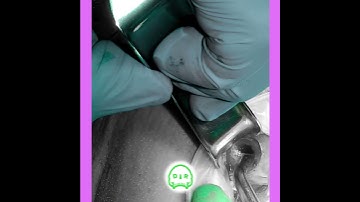 Sinus Lift: Sinus Membrane Exposure with Breathing @drwahan