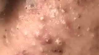 Huge Acne Pimples Blackheads Popping Up Satisfying with Oddly Calm Music screenshot 2