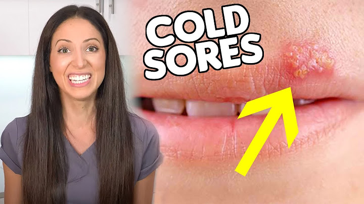 How to fix a cold sore fast