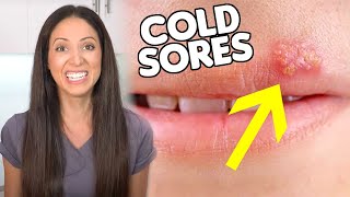 What are COLD SORES & How To Get Rid of Them