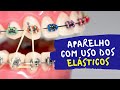 Para que servem os elásticos no aparelho fixo | DentalKids