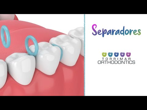 Video: ¿Los separadores duelen más que los brackets?