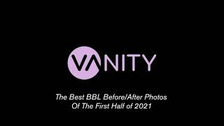 The Best BBL Before and Afters of The First Half of 2021 #BBL