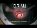 LEFT STAPEDOTOMY WITH INTACT STAPEDIAL TENDON AND DEHISCENT FACIAL NERVE