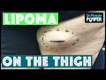 A Lipoma Excised from the Right Posterior Thigh on a Popaholic's Mom!