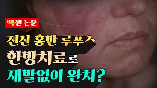 루푸스 증상, 한방 치료로 개선 가능하다? 전신 홍반 루푸스 치료 사례