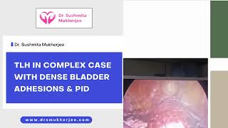 TLH in Complex Case with Dense Bladder Adhesions & PID