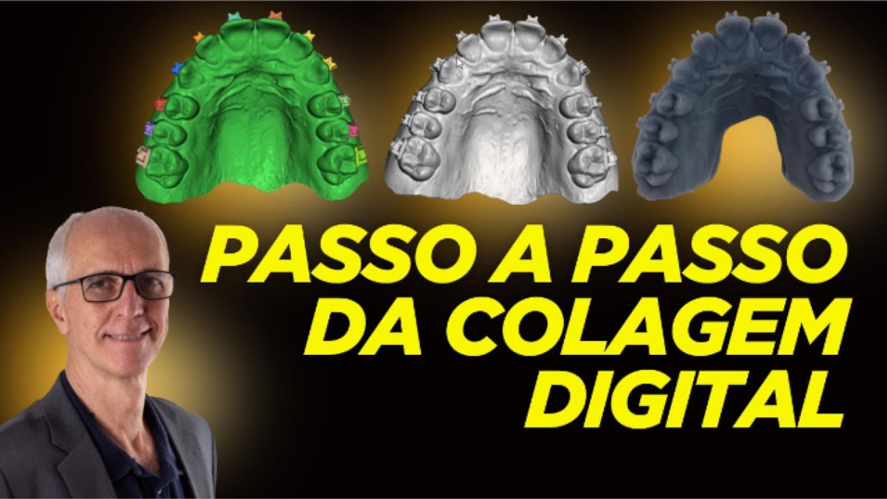Colagem Indireta Digital: Do STL à Colagem em Boca