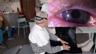 When Epley Fails: Posterior Canal BPPV Case (Epley vs Bascule)
