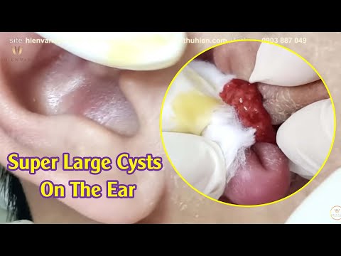 Video Super Large Cysts On The Ear | Điều trị mụn hiệu quả... - youtube