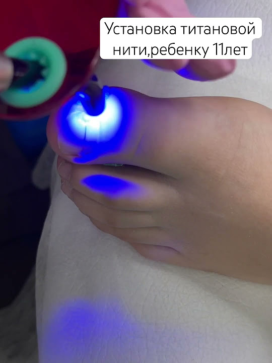 Титановая нить при врастании ногтей - YouTube
