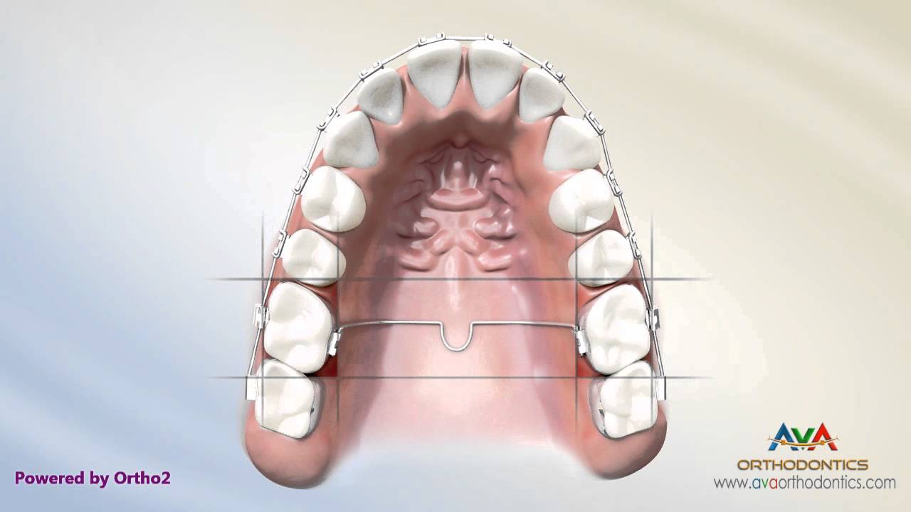 Orthodontic Rubber Bands in Spring, League City, & Cypress, TX