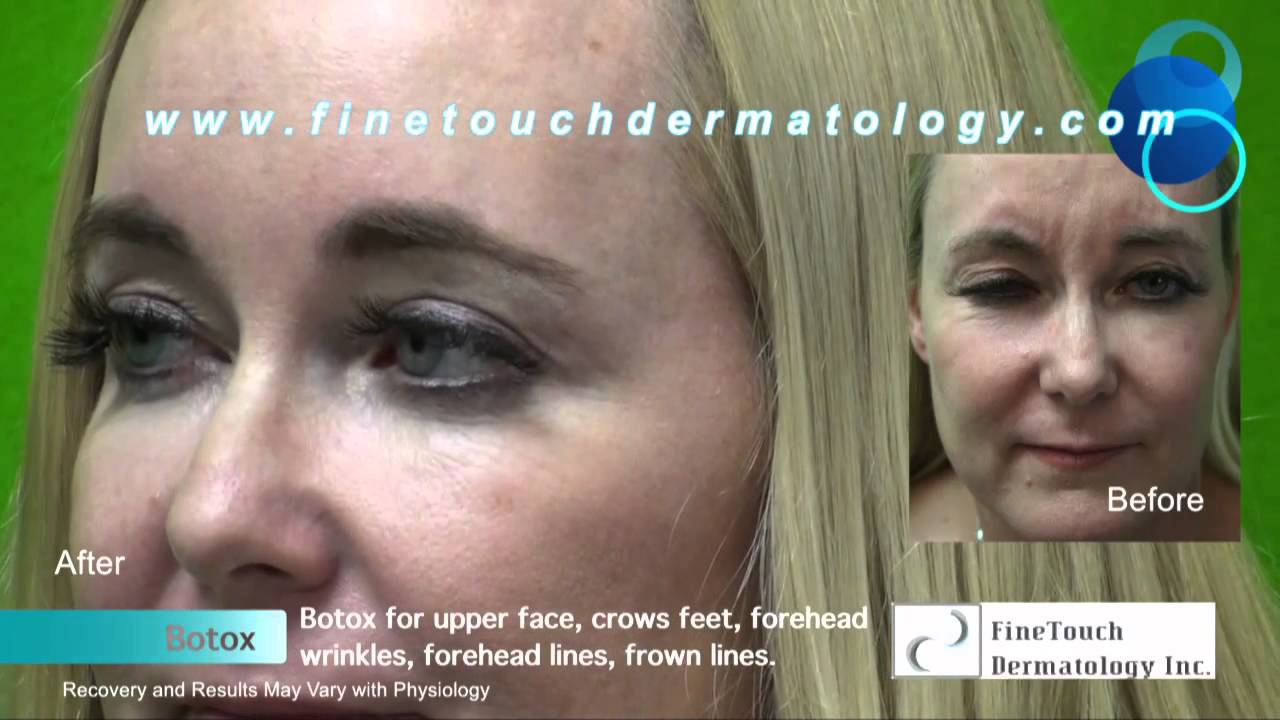 Botox Forehead Wrinkles Treatment: Santa Monica Patient Before and After Botox